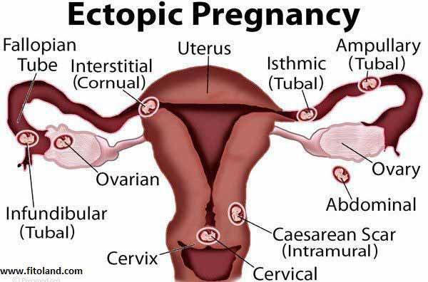 Ectopic-Pregnancy-Emplicit-Implantation