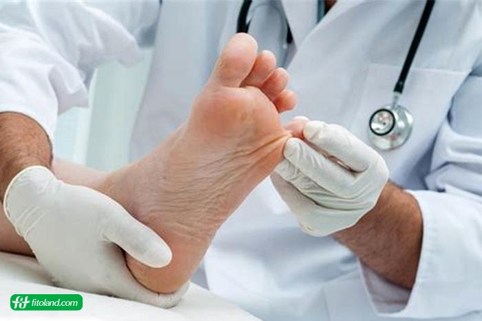 درمان زخم پای دیابتی براساس انواع زخم پای دیابتی