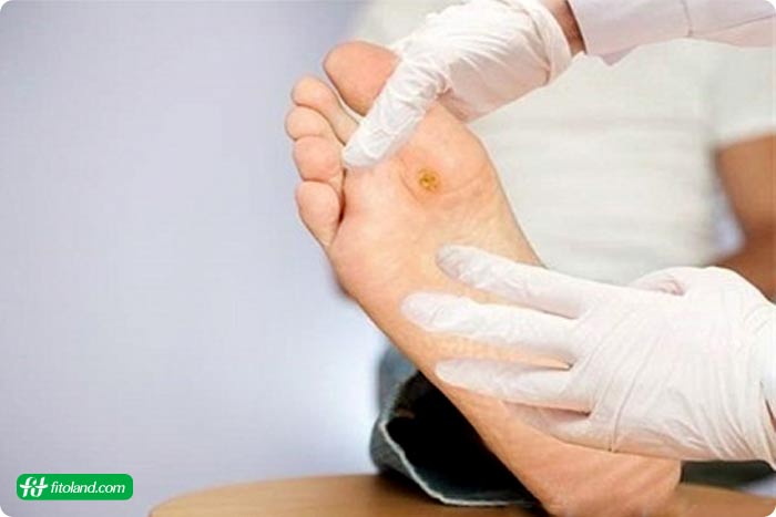 شناخت انواع زخم پای دیابتی برای درمان زخم پای دیابتی