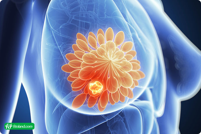 سرطان سینه با ماموگرافی